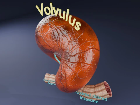 Volvulus intestine obstruction 3D Model