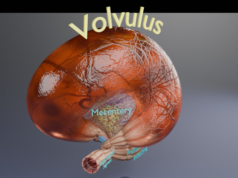 Volvulus intestine obstruction 3D Модель