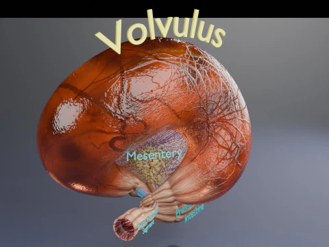 Volvulus intestine obstruction 3D Model