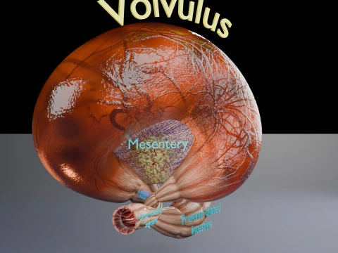 Volvulus intestine obstruction 3D Model