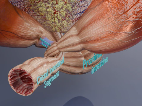 Volvulus intestine obstruction 3D Model