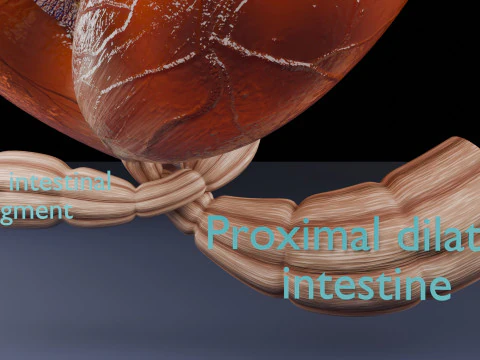 Volvulus intestine obstruction 3D Model