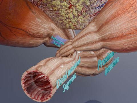 Volvulus intestine obstruction 3D Модель