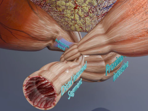 Volvulus intestine obstruction 3D Model