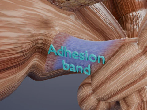 Volvulus intestine obstruction 3D Model