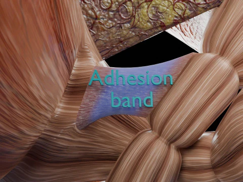 Volvulus intestine obstruction 3D Model