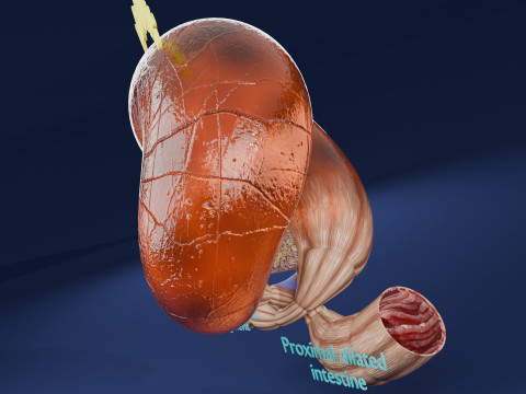 Volvulus intestine obstruction 3D Модель