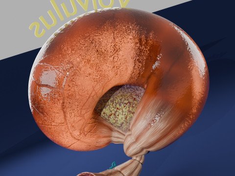 Volvulus intestine obstruction 3D Модель