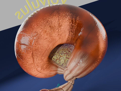 Volvulus intestine obstruction 3D Model