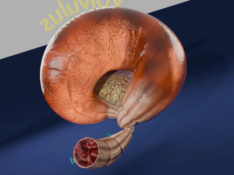Volvulus intestine obstruction 3D Model