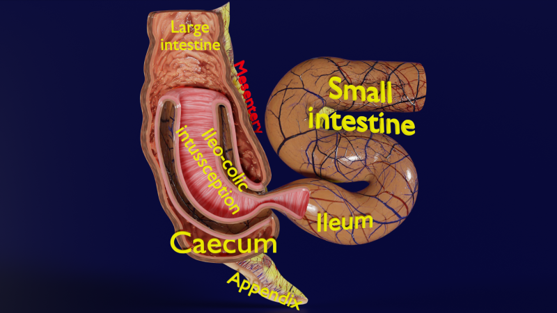 Intussusception intestine ileocolic obstruction 3D Модель .c4d .max .obj .3ds .fbx .stl .blend