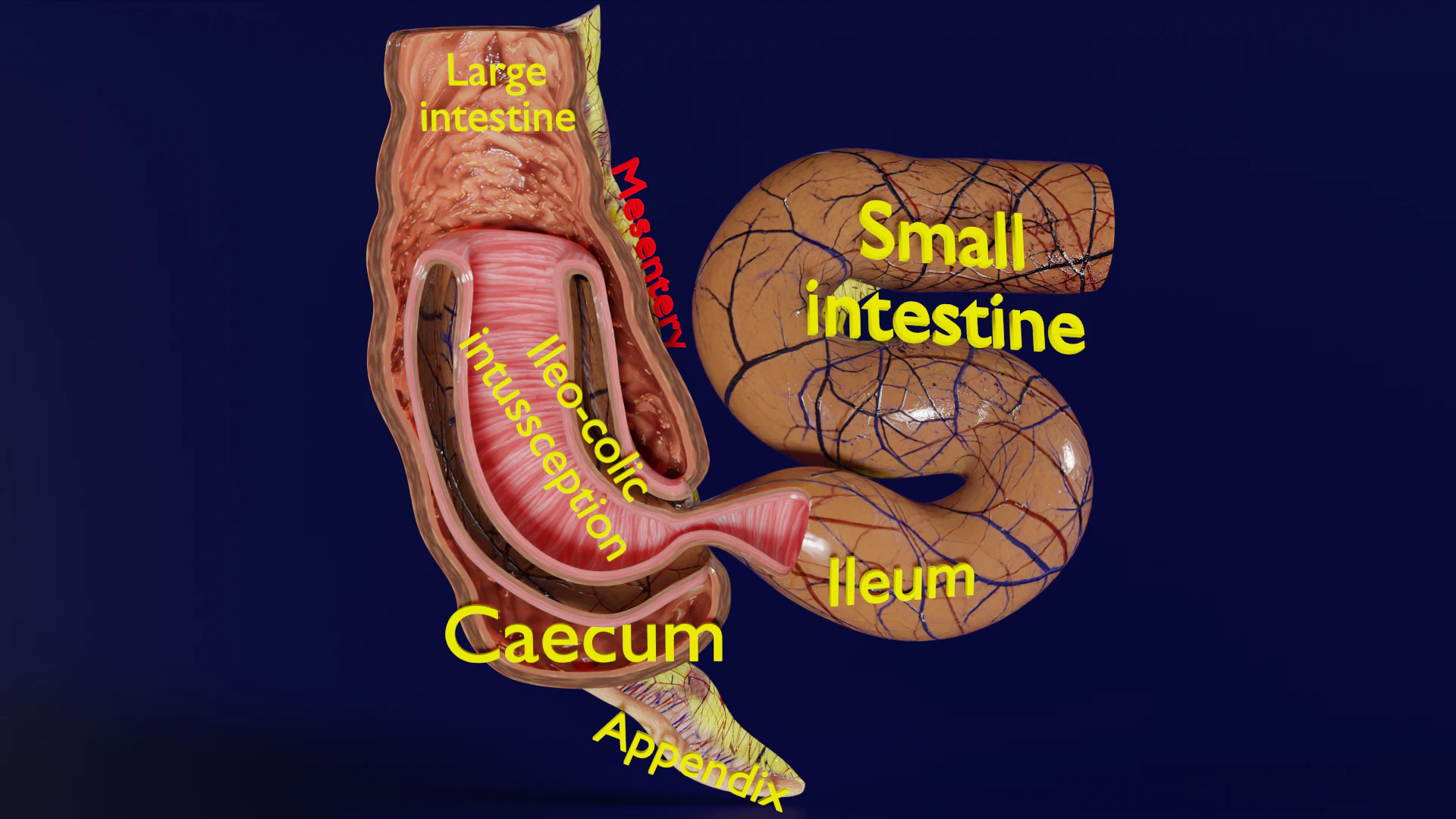 Intussusception intestine ileocolic obstruction 3D Model .c4d .max .obj .3ds .fbx .stl .blend 