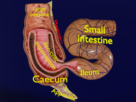 Intussusception intestine ileocolic obstruction Modello 3D