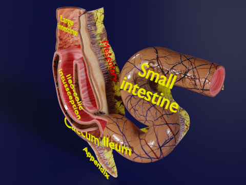 Intussusception intestine ileocolic obstruction 3D Модель