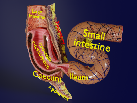 Intussusception intestine ileocolic obstruction 3D Модель