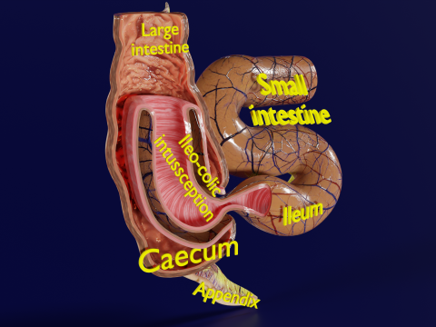 Intussusception intestine ileocolic obstruction 3D Модель