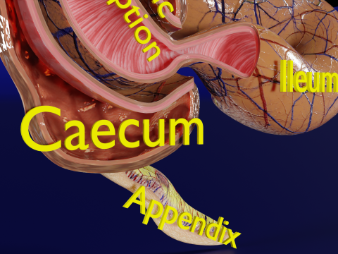 Intussusception intestine ileocolic obstruction 3D Модель
