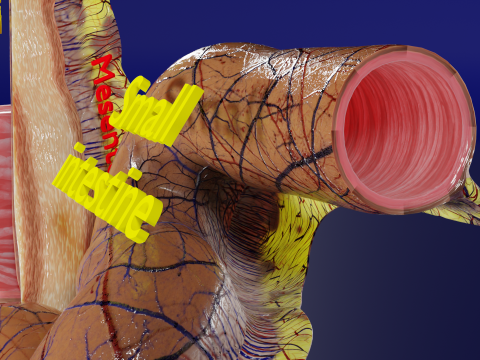 Intussusception intestine ileocolic obstruction 3D Модель