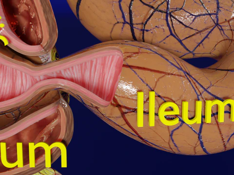 Intussusception intestine ileocolic obstruction 3D Model