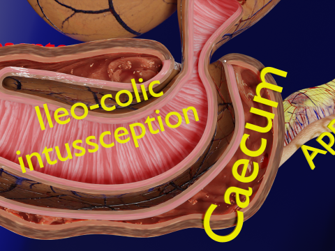 Intussusception intestine ileocolic obstruction 3D Модель