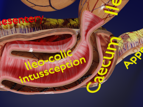 Intussusception intestine ileocolic obstruction 3D Модель