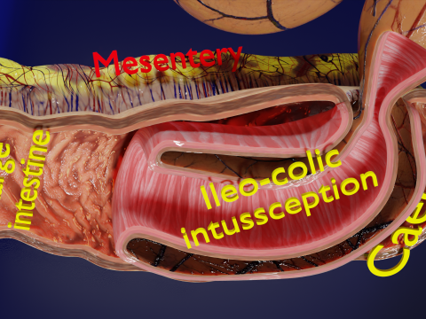 Intussusception intestine ileocolic obstruction 3D Модель