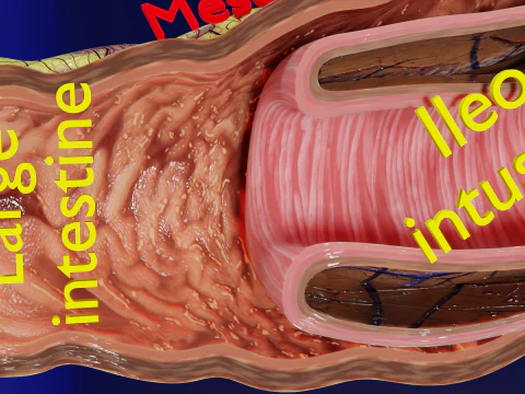 Intussusception intestine ileocolic obstruction 3D Model