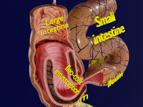 Intussusception intestine ileocolic obstruction 3D Модель