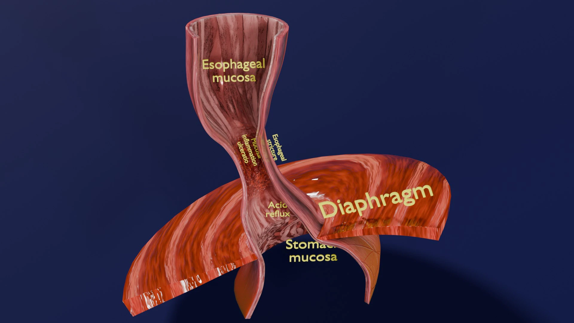 Gastro oesophageal reflux disease 3D Model .c4d .max .obj .3ds .fbx .stl .blend 
