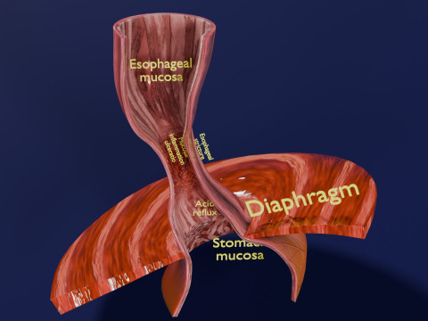 Gastro oesophageal reflux disease 3Dモデル