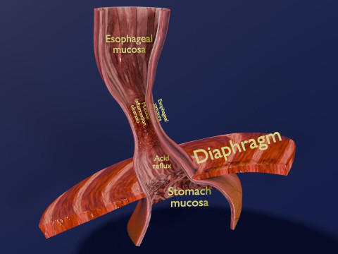 Gastro oesophageal reflux disease 3D 모델