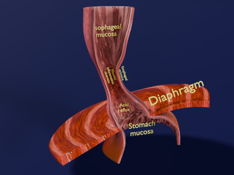 Gastro oesophageal reflux disease 3D 모델