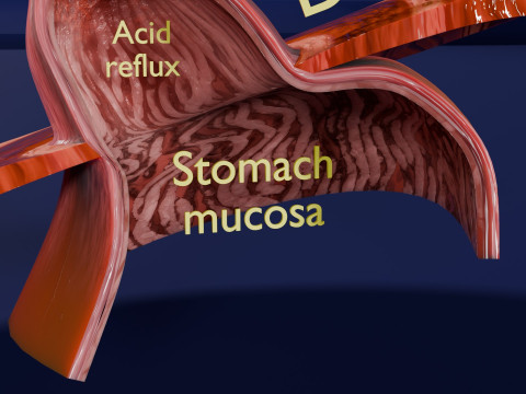 Gastro oesophageal reflux disease 3D 모델