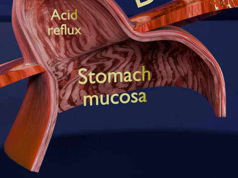 Gastro oesophageal reflux disease 3D Model