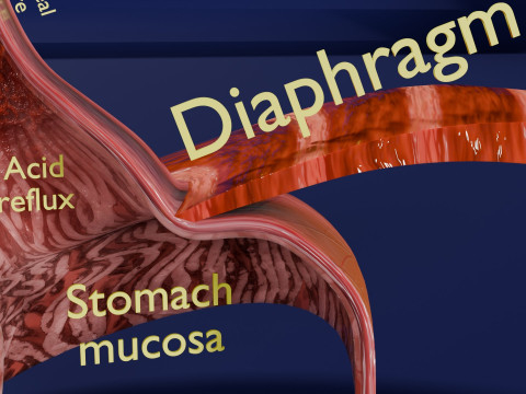 Gastro oesophageal reflux disease 3D 모델