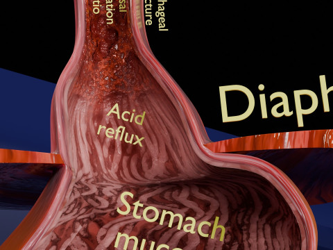 Gastro oesophageal reflux disease 3D 모델