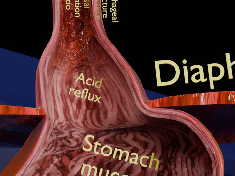 Gastro oesophageal reflux disease 3D Model