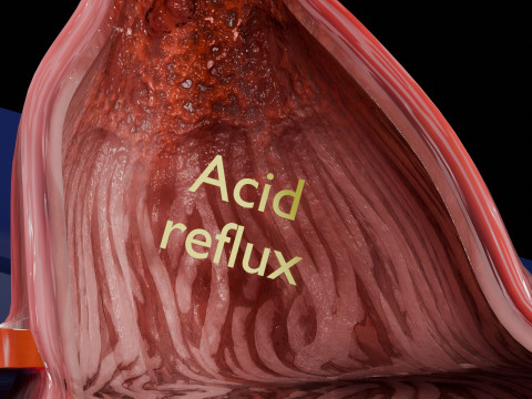 Gastro oesophageal reflux disease 3D 모델