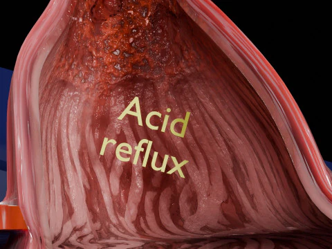 Gastro oesophageal reflux disease 3D Model
