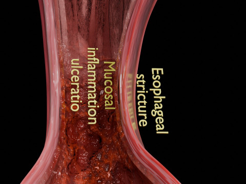 Gastro oesophageal reflux disease 3D 모델