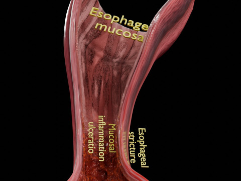 Gastro oesophageal reflux disease 3D 모델