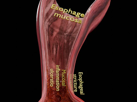 Gastro oesophageal reflux disease 3D Model