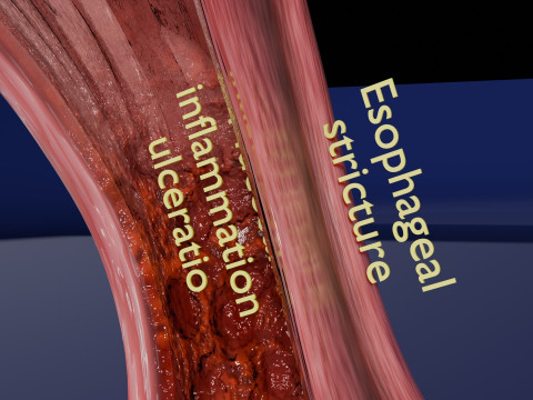 Gastro oesophageal reflux disease 3D 모델