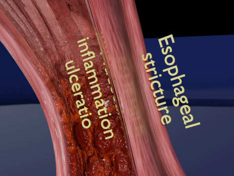 Gastro oesophageal reflux disease 3D Model
