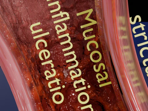 Gastro oesophageal reflux disease 3D Model