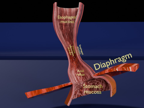 Gastro oesophageal reflux disease 3D 모델