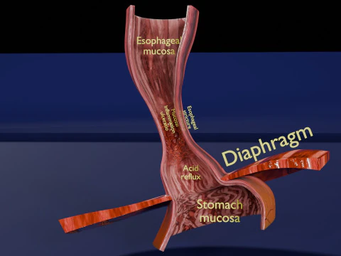Gastro oesophageal reflux disease 3D Model