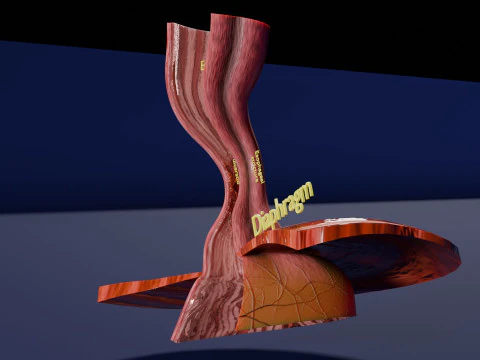 Gastro oesophageal reflux disease 3D Model
