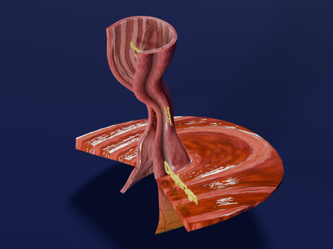Gastro oesophageal reflux disease 3D 모델