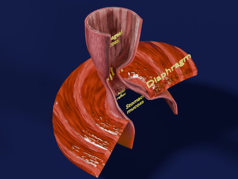 Gastro oesophageal reflux disease 3D 모델
